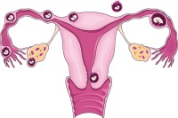 بارداری خارج رحمی